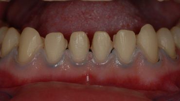 Микродентия или маленькие зубы