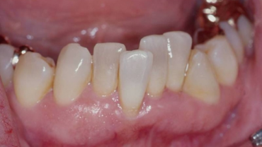 Причины скученности зубного ряда