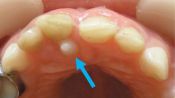 Удаления сверхкомплектных зубов