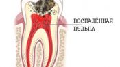 Как удаляют нерв из зуба