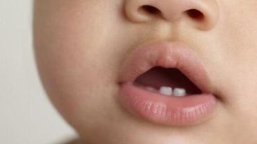 Причины раннего прорезывания зубов