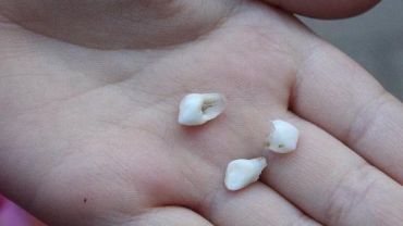 Показания и методика удаления молочных зубов