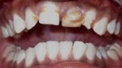 Гипоплазия зубной эмали