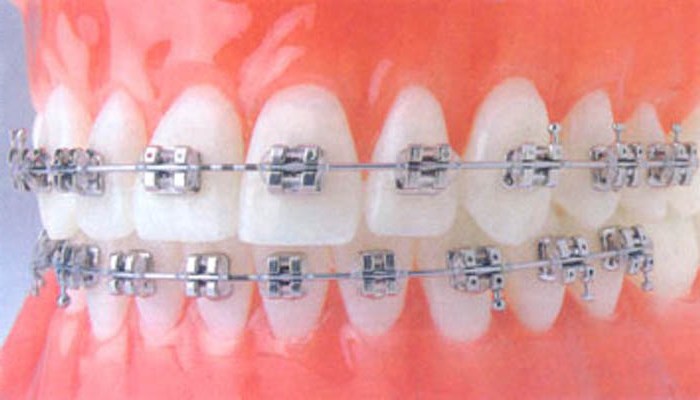 Аппаратурный метод как основной при лечении ортодонтических аномалий