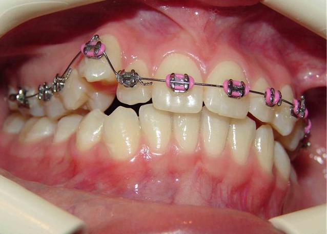 Аномалия положения отдельных зубов