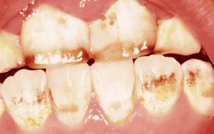 Флюорозные пятна