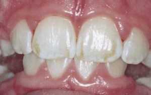 Флюорозные пятна