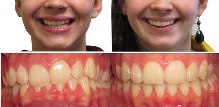 Тактика лечения глубокого перекрытия зубов