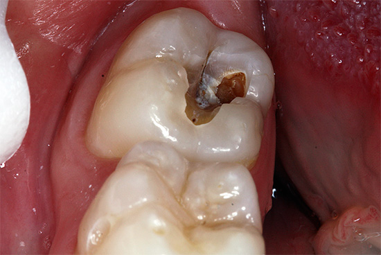 Причины кариозного процесса в зубе мудрости