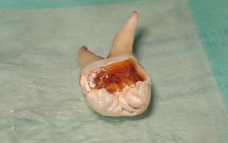 Клиническая картина кариеса восьмых зубов