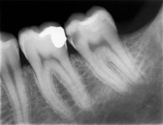Рентгенологическое обследование при кариесе зубов