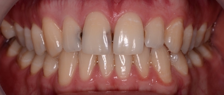 Проявления кариеса фронтальных зубов