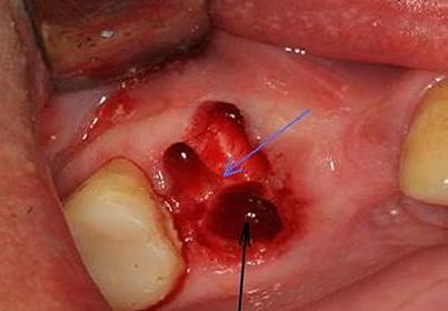 Острые края альвеолы - частое осложнение после удаления зуба