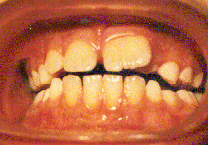 Макродентия - увеличение размера зуба