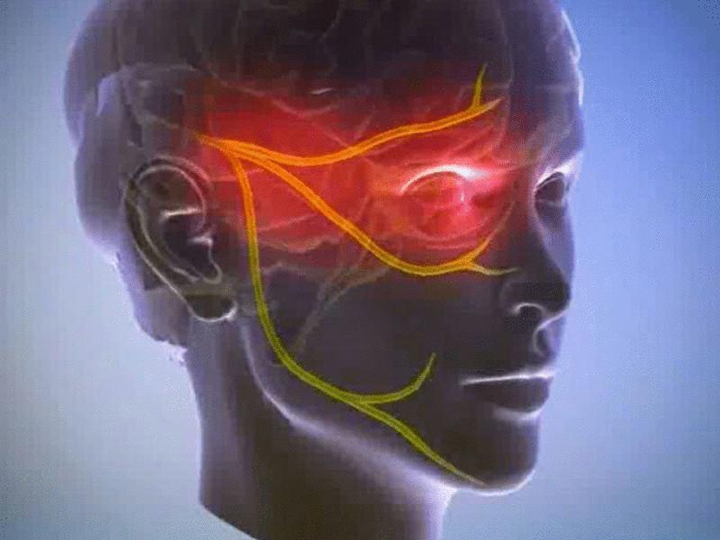 Причины возникновения невралгии тройничного нерва
