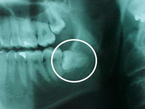 Показания к удалению нижних восьмых зубов