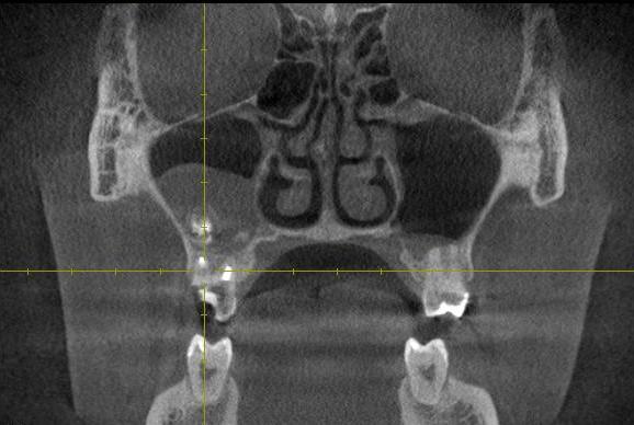 Рентгенография при одонтогенных синуситах