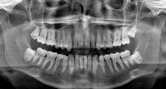 Основные показания к удалению зубов мудрости