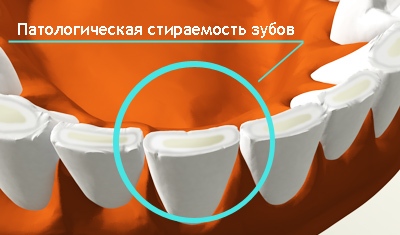 Симптомы и последствия чрезмерной стираемости зубов