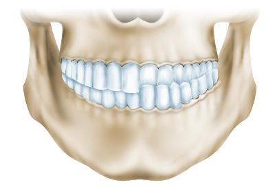Симптомы и диагностика перекрестного соотношения зубных рядов
