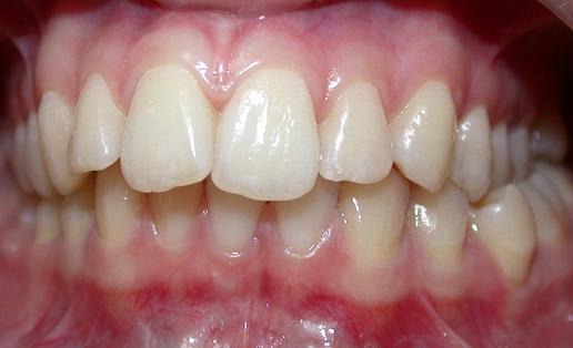 Разновидности перекрестного соотношения зубных рядов