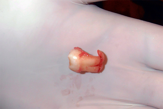 Осложнения во время удаления зуба