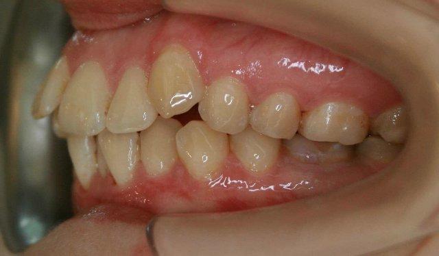 Причины и лечение протрузии зубов