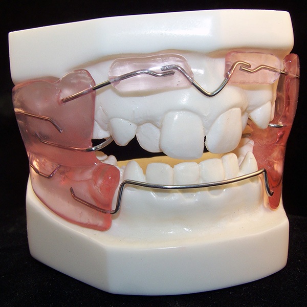 Разновидности и характеристика основных ортодонтических конструкций