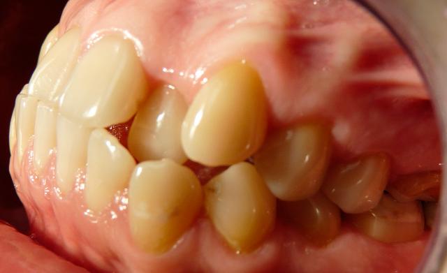 Тактика лечения ретрузии зубов