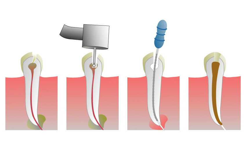 Основные этапы лечения каналов зуба
