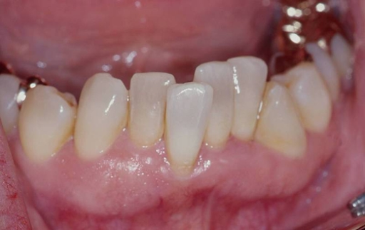 Причины тесного положения зубов