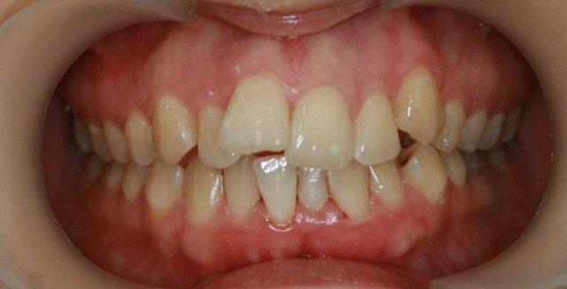 Тактика лечения скученности зубов
