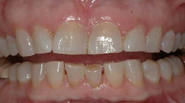 Причины и разновидности стирания зубов