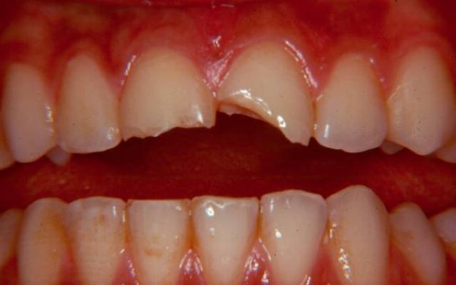 Травма зуба может привести к воспалению пульпы