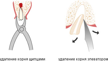 Какими инструментами удаляют корни зубов