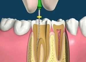 Методы удаления нерва зуба