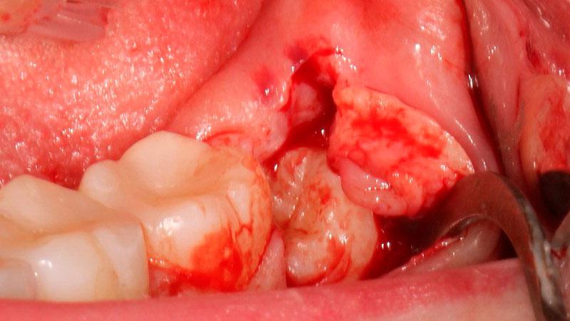 Способы удаления нижних восьмых зубов