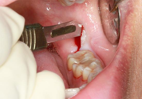 Последовательность атипичного удаления зуба