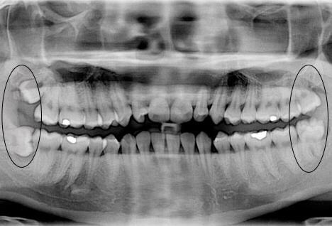 Положение зубов мудрости в челюсти