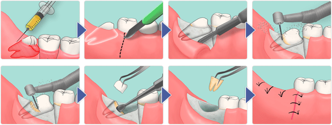 Показания к удалению восьмых зубов