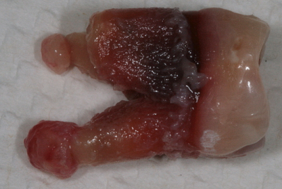 Удаление зуба - метод лечение апикального периодонтита