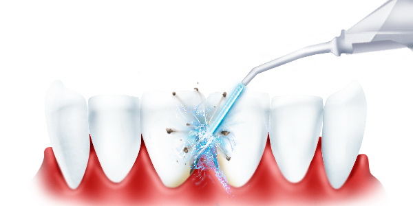 обработка зубов ирригатором